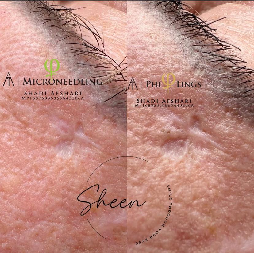 Microneedling Service